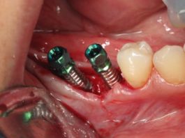 İmplant Diş Nasıl Takılır ?| İmplant Fiyatları implant dis fiyatlari