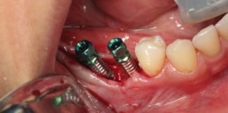 İmplant Diş Nasıl Takılır ?| İmplant Fiyatları implant dis fiyatlari